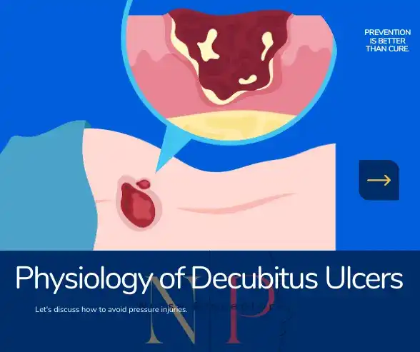 depiction of pressure ulcer on sacrum